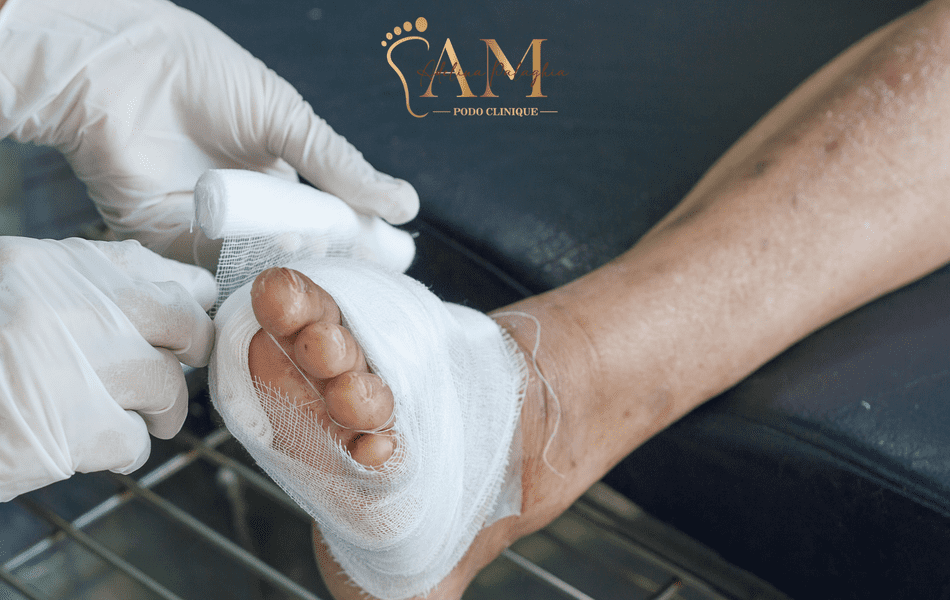 Piciorul diabetic: o complicație gravă ce poate fi prevenită