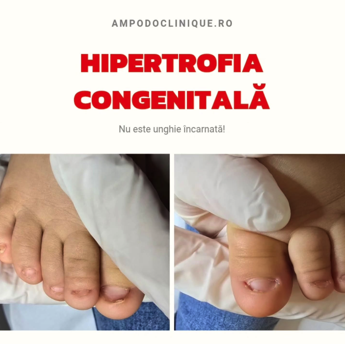 HIPERTROFIE CONGENITALĂ A FALDURILOR UNGHIALE
